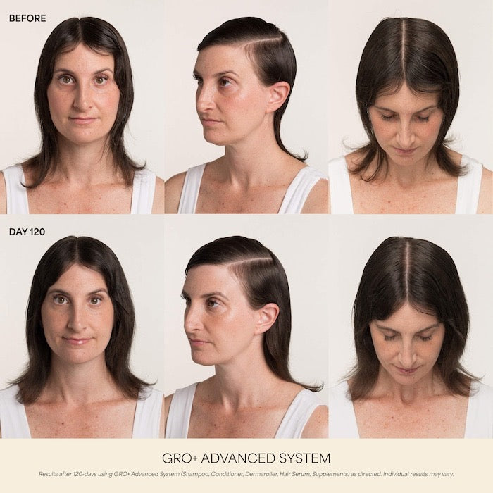 0.25 mm GRO+ Advanced Scalp Dermaroller