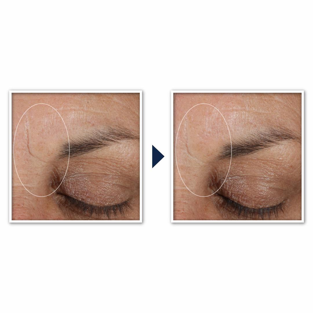 Retinol Correxion Deep Wrinkle Targeted Patches