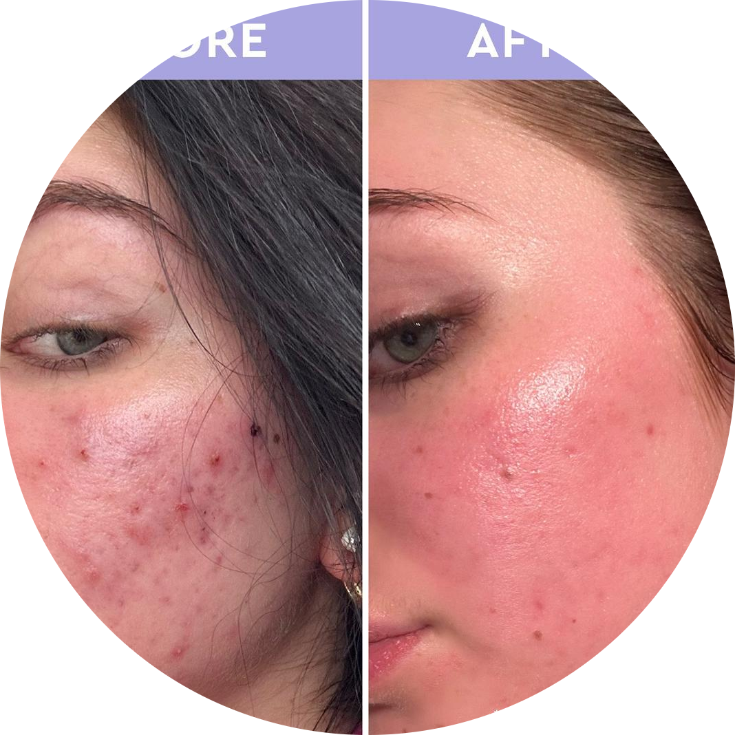 Spot A Spot Exfoliating Acne Solution