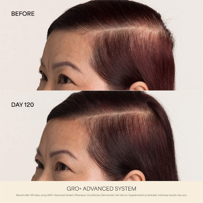 0.25 mm GRO+ Advanced Scalp Dermaroller