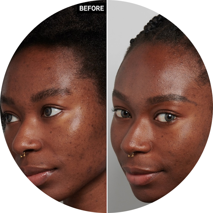 Tranexamic Acid Hyperpigmentation Treatment