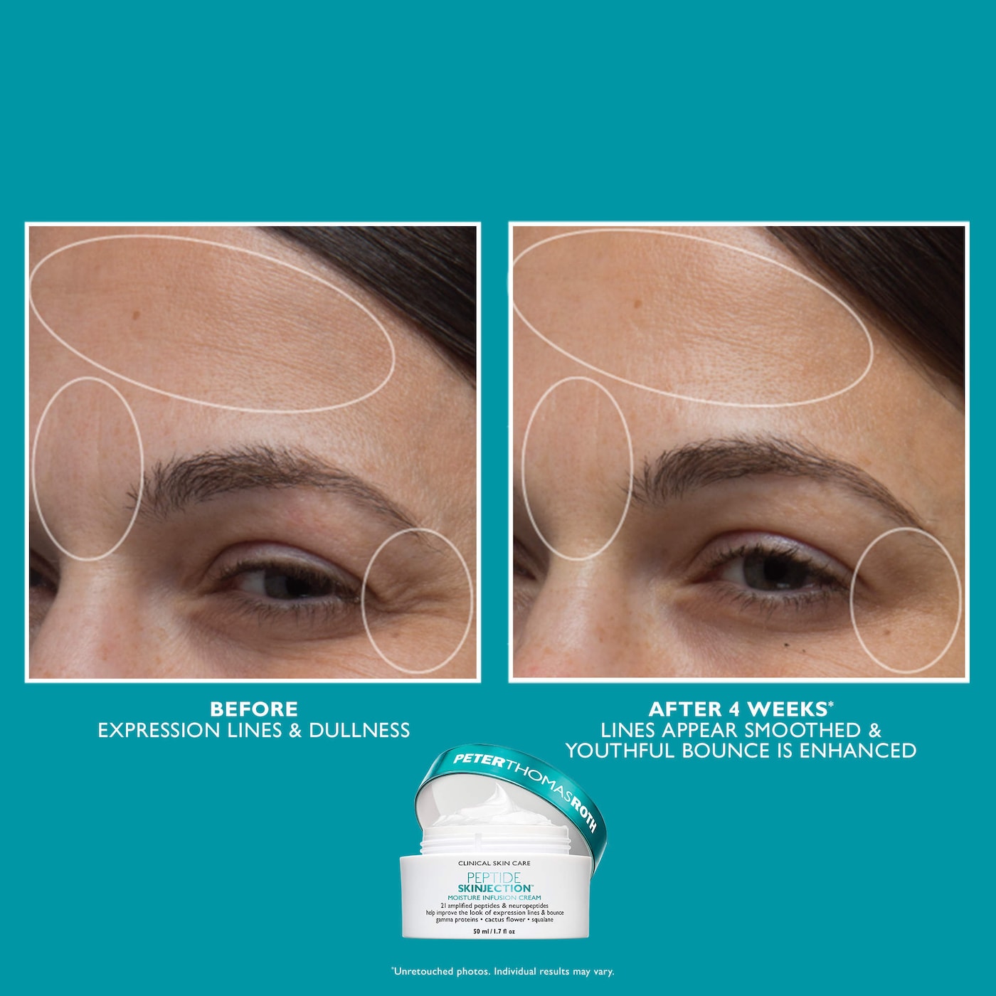 Peptide Skinjection™ Set